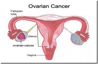 10 early warning signs of ovarian cancer you shouldn’t ignore!