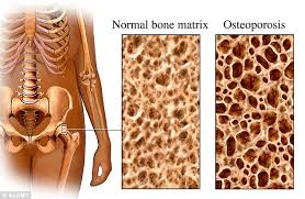 Osteoporosis Is Scurvy of the Bone, Not Calcium Deficiency, FACT!