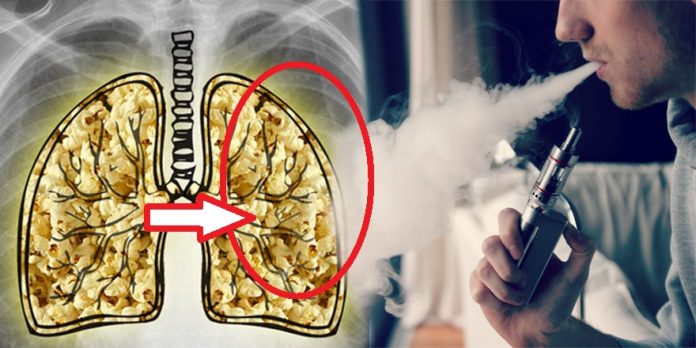 CONFIRMED: E-CIGARETTES CAUSE A HORRIBLE INCURABLE DISEASE CALLED ‘POPCORN LUNG’. WORSE THAN LUNG CANCER!