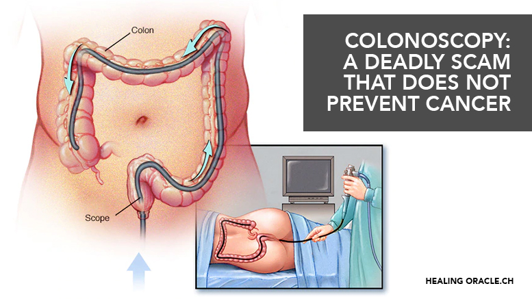 COLONOSCOPY’S ARE  LETHAL AND DO NOT DETECT CANCER